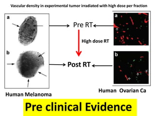 Vascular density in experimental tumor irradiated with high dose per fraction
Pre RT
Post RT
Human Melanoma
Human Ovarian Ca
High dose RT
Pre clinical Evidence
 