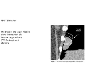 4D CT Simulator
The trace of the target motion
allow the creation of a
internal target volume
(ITV) for treatment
planning
 