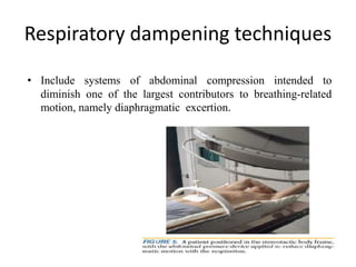 Respiratory dampening techniques
• Include systems of abdominal compression intended to
diminish one of the largest contributors to breathing-related
motion, namely diaphragmatic excertion.
 