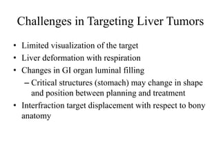 Challenges in Targeting Liver Tumors
• Limited visualization of the target
• Liver deformation with respiration
• Changes in GI organ luminal filling
– Critical structures (stomach) may change in shape
and position between planning and treatment
• Interfraction target displacement with respect to bony
anatomy
 