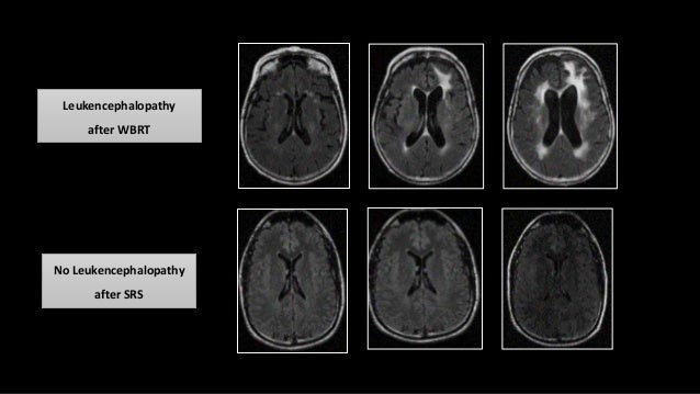 Radiosurgery For Brain Metastases