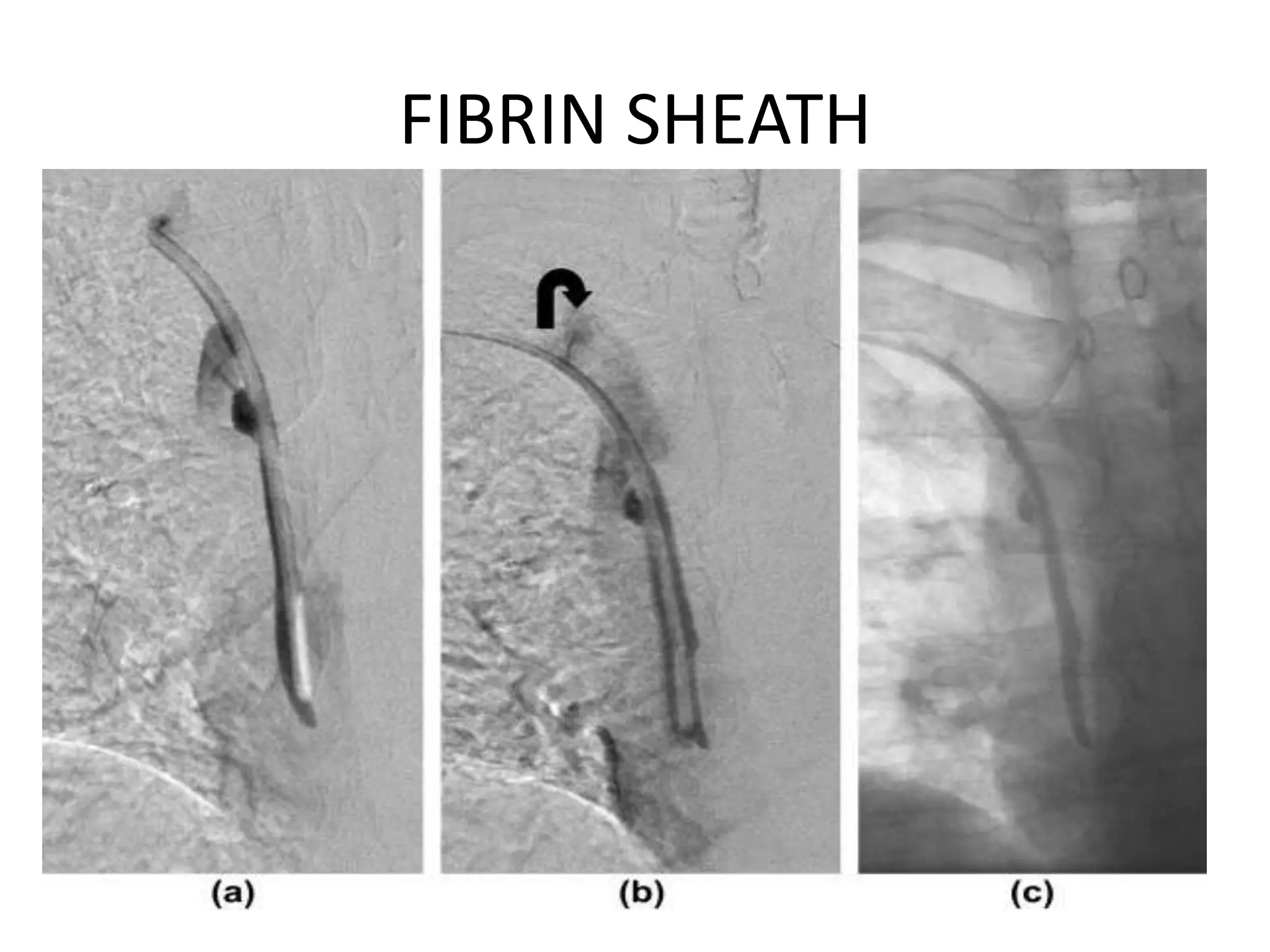 FIBRIN SHEATH
 