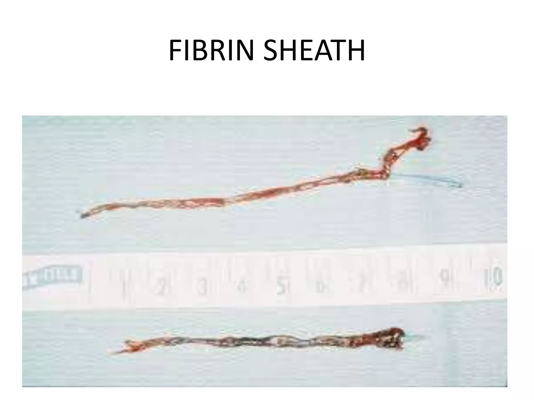 FIBRIN SHEATH
 