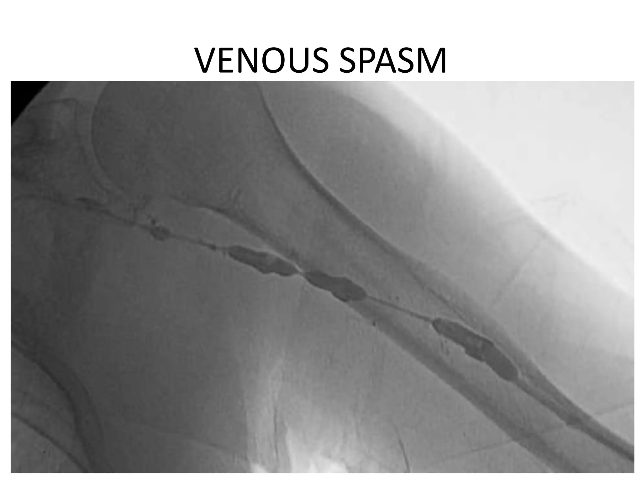 VENOUS SPASM
 