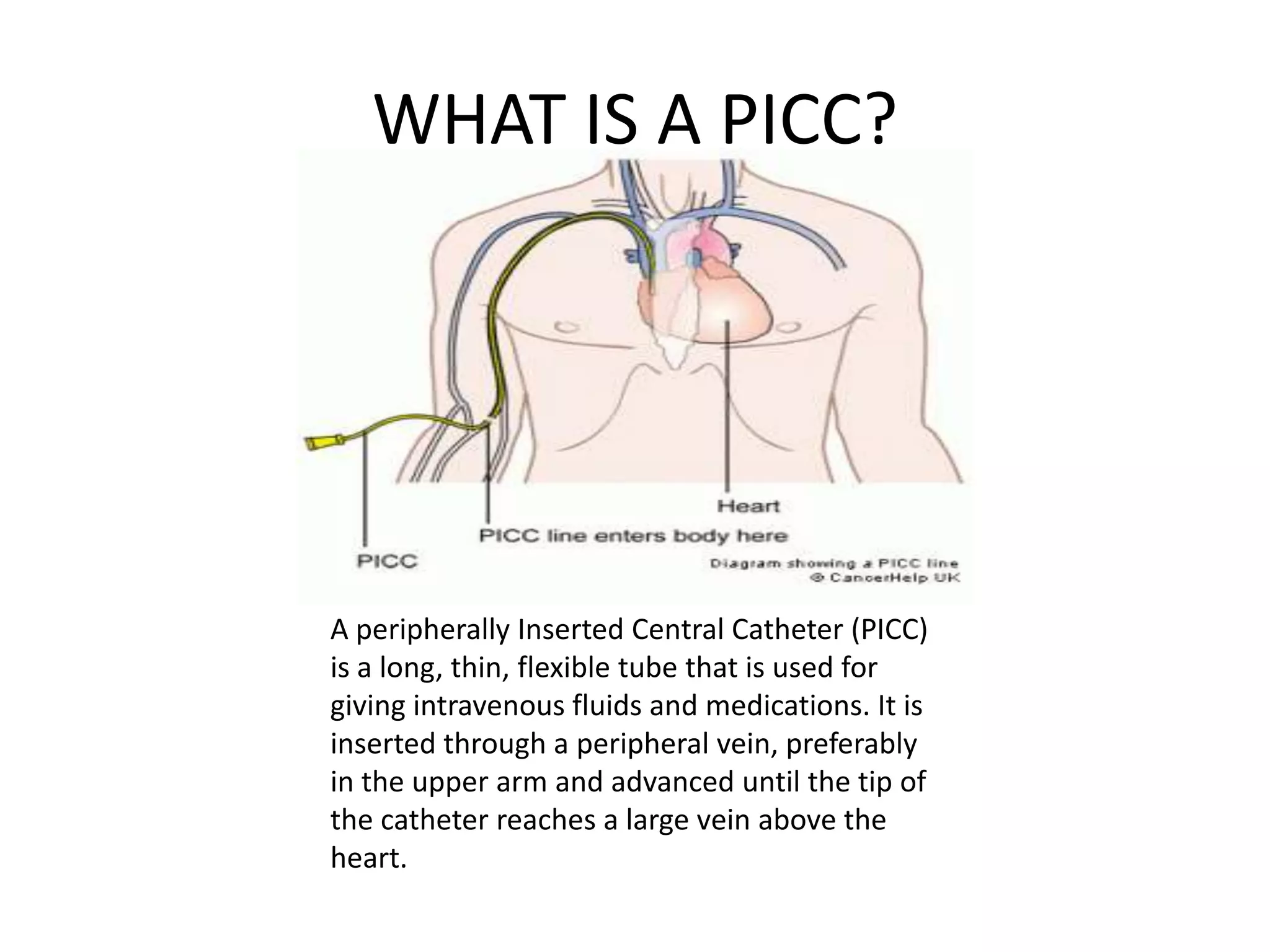 WHAT IS A PICC?
A peripherally Inserted Central Catheter (PICC)
is a long, thin, flexible tube that is used for
giving intravenous fluids and medications. It is
inserted through a peripheral vein, preferably
in the upper arm and advanced until the tip of
the catheter reaches a large vein above the
heart.
 