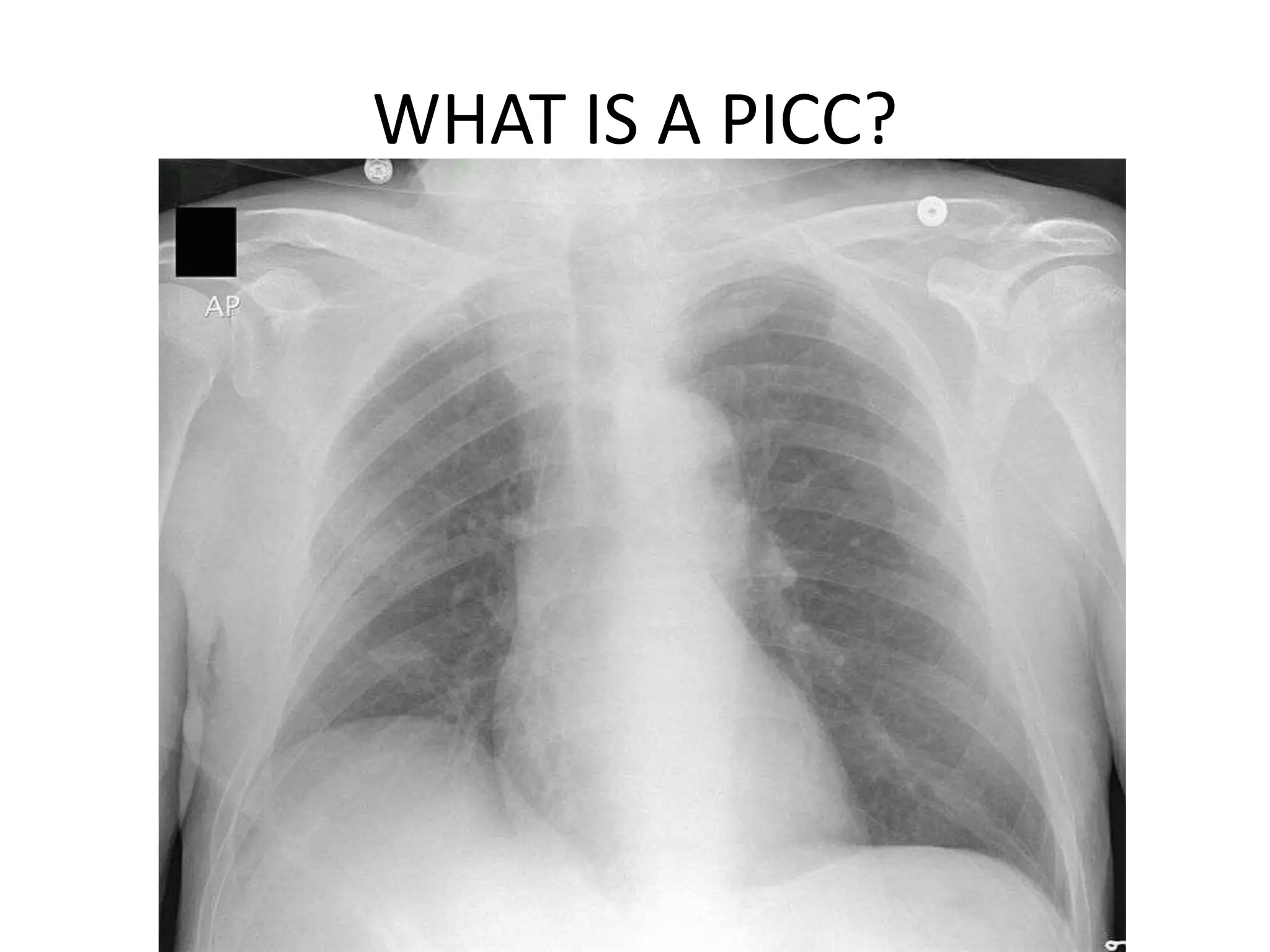 WHAT IS A PICC?
 
