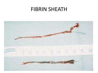 FIBRIN SHEATH
 