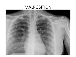 MALPOSITION
 