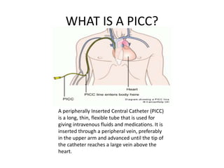 WHAT IS A PICC?
A peripherally Inserted Central Catheter (PICC)
is a long, thin, flexible tube that is used for
giving intravenous fluids and medications. It is
inserted through a peripheral vein, preferably
in the upper arm and advanced until the tip of
the catheter reaches a large vein above the
heart.
 
