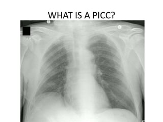 WHAT IS A PICC?
 