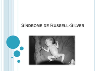 Síndrome de Russell-Silver 