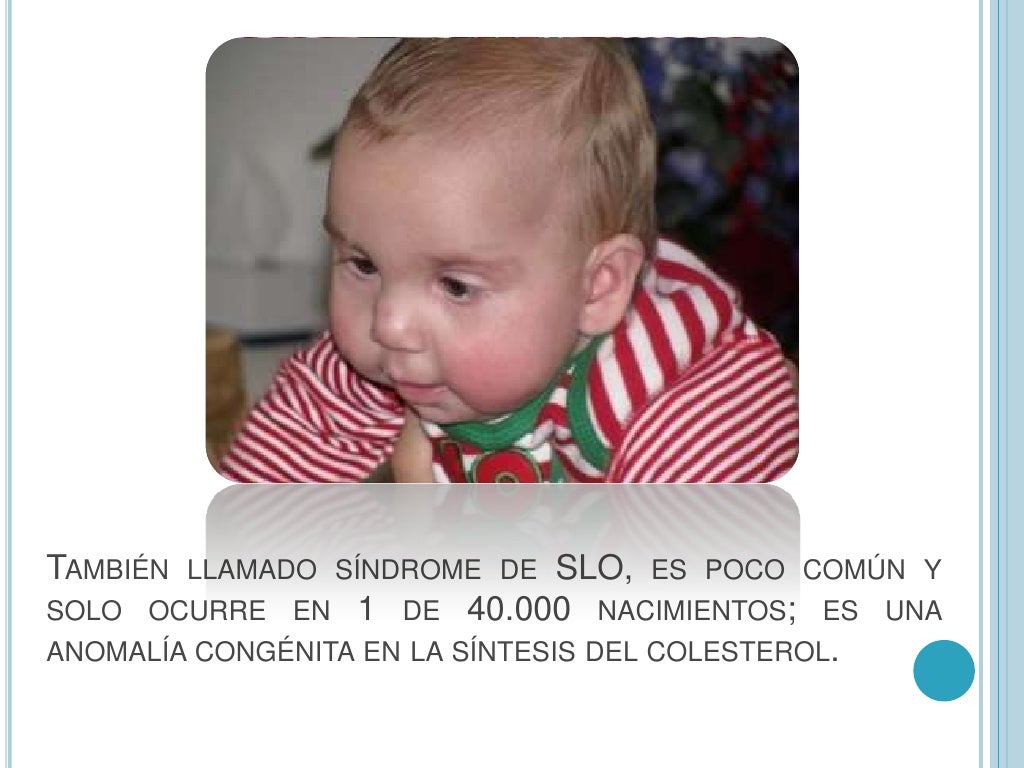 Sindrome de rusell silver