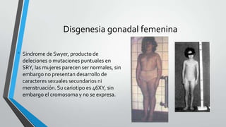 Disgenesia gonadal femenina
• Sindrome de Swyer, producto de
deleciones o mutaciones puntuales en
SRY, las mujeres parecen ser normales, sin
embargo no presentan desarrollo de
caracteres sexuales secundarios ni
menstruación. Su cariotipo es 46XY, sin
embargo el cromosoma y no se expresa.