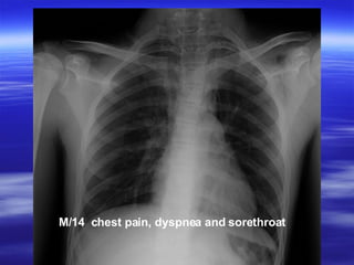 M/14  chest pain, dyspnea and sorethroat  
