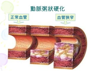 動脈粥狀硬化 正常血管 血管狹窄 