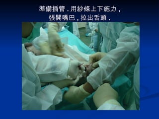 準備插管 . 用紗條上下施力 , 張開嘴巴 , 拉出舌頭 . 