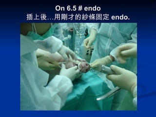 On 6.5 # endo 插上後…用剛才的紗條固定 endo. 