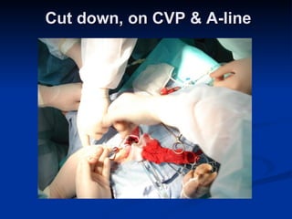 Cut down, on CVP & A-line 