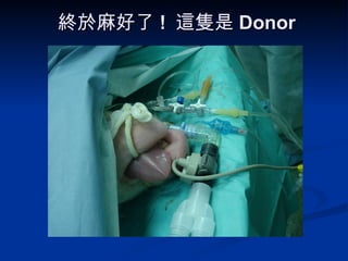 終於麻好了 !  這隻是 Donor 