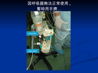 因呼吸器無法正常使用 , 暫時用手擠… propofol pavulon 