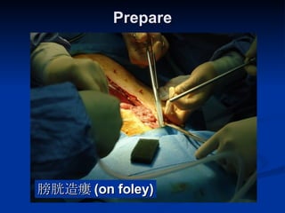 Prepare  膀胱造瘻 (on foley) 