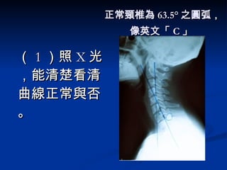正常頸椎為 63.5° 之圓弧， 像英文「 C 」   （ 1 ）照 X 光，能清楚看清曲線正常與否。 