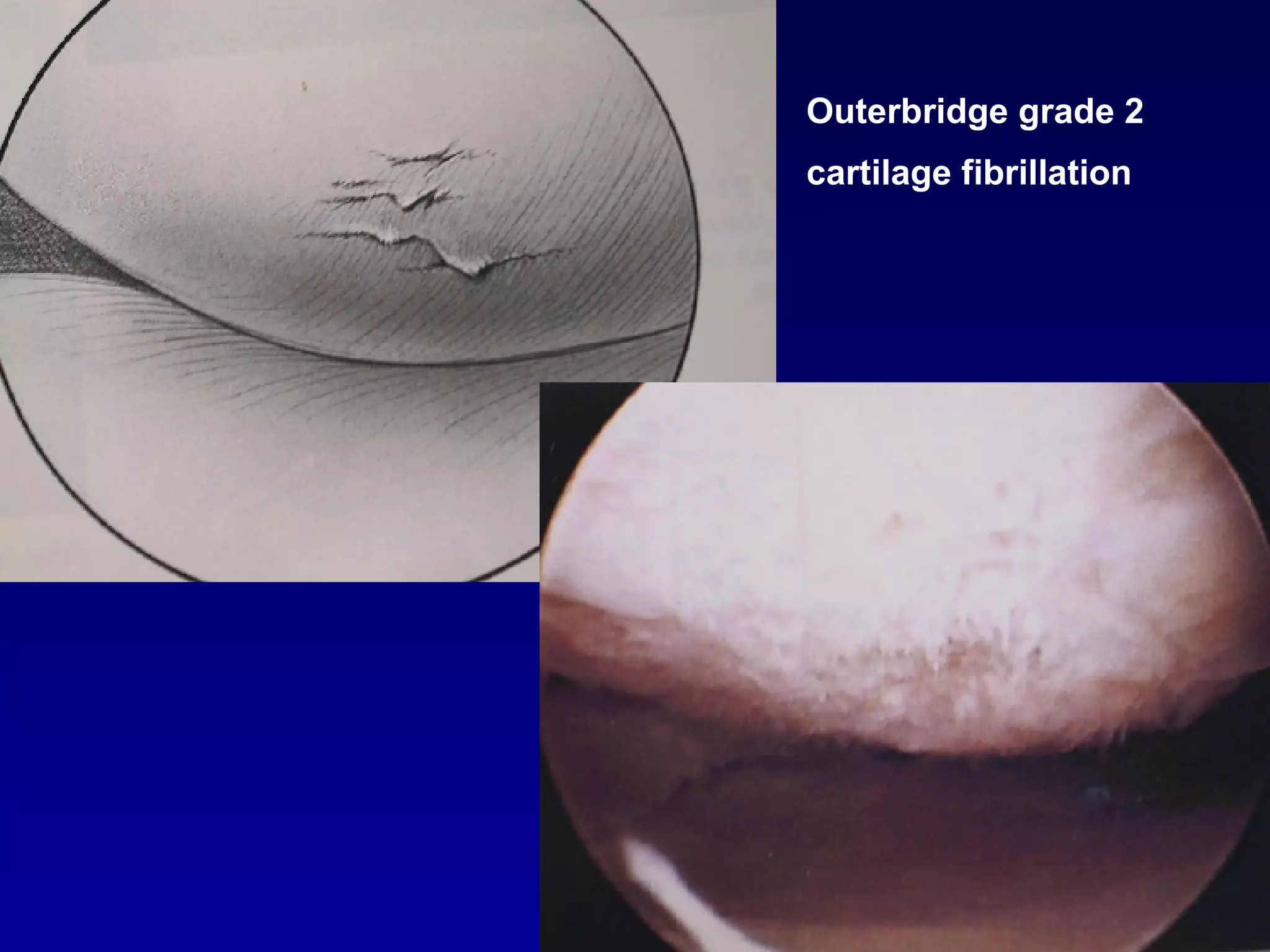 Outerbridge grade 2 cartilage fibrillation 