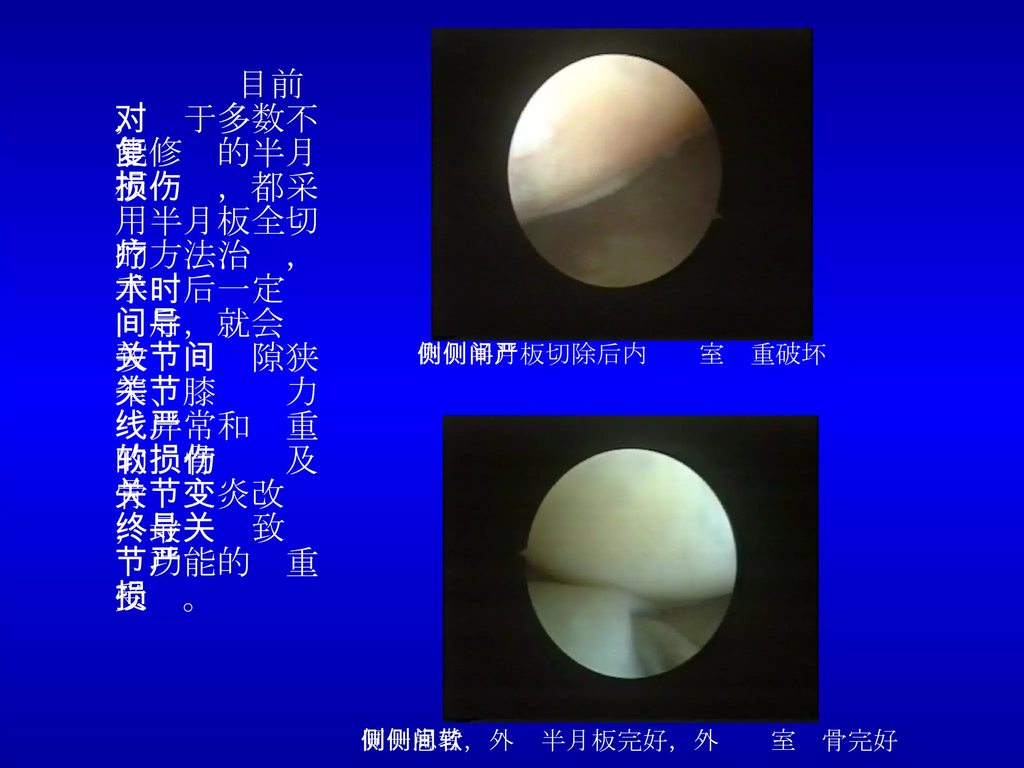 目前，对于多数不能修复的半月板损伤，都采用半月板全切的方法治疗，手术后一定时间后，就会导致关节间隙狭窄、膝关节力线异常和严重的软骨损伤及骨关节炎改变，最终导致关节功能的严重受损。 内侧半月板切除后内侧间室严重破坏 同一患者，外侧半月板完好，外侧间室软骨完好 