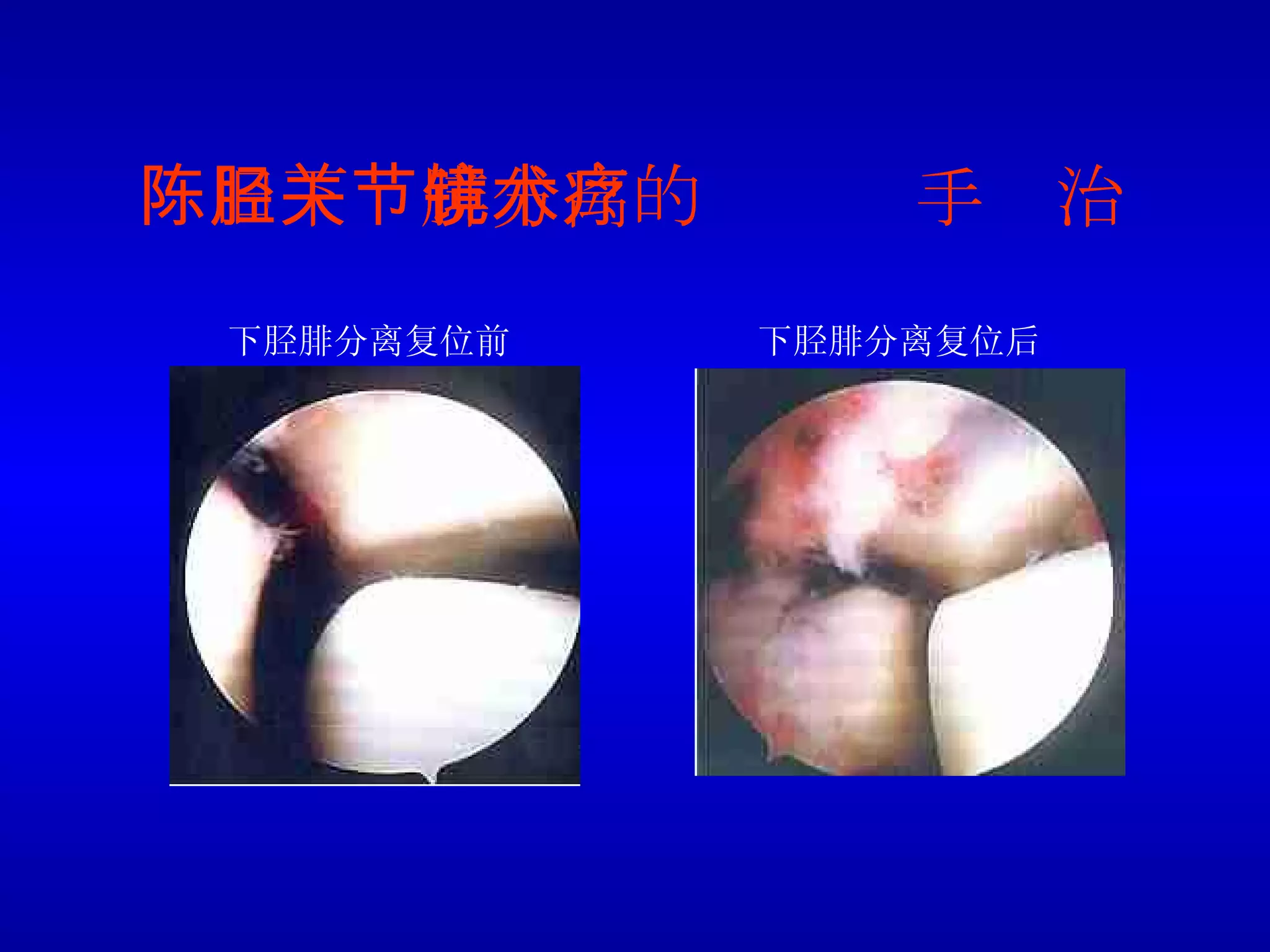 陈旧下胫腓分离的关节镜手术治疗 下胫腓分离复位前 下胫腓分离复位后 