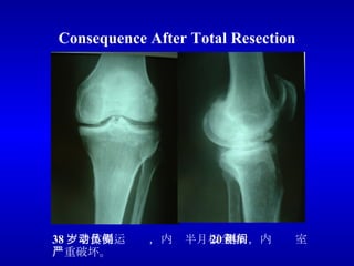 Consequence After Total Resection 38 岁老体操运动员，内侧半月板全切 20 年后，内侧间室严重破坏。 