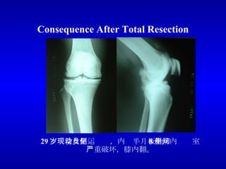 Consequence After Total Resection 29 岁现役女足运动员，内侧半月板全切 8 年，内侧间室严重破坏，膝内翻。 