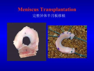Meniscus Transplantation   完整异体半月板移植 