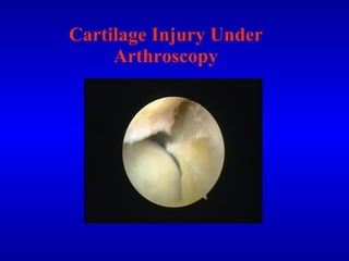 Cartilage Injury Under Arthroscopy 