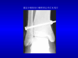 通过小辅助切口螺栓固定术后 X 线片 