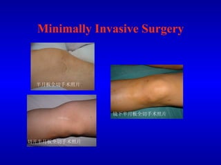 Minimally Invasive Surgery 切开半月板全切手术照片 镜下半月板全切手术照片 半月板全切手术照片 