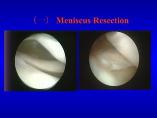 （一） Meniscus Resection 