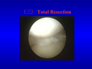 （三） Total Resection 