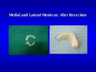 Medial and Lateral Meniscus After Resection 