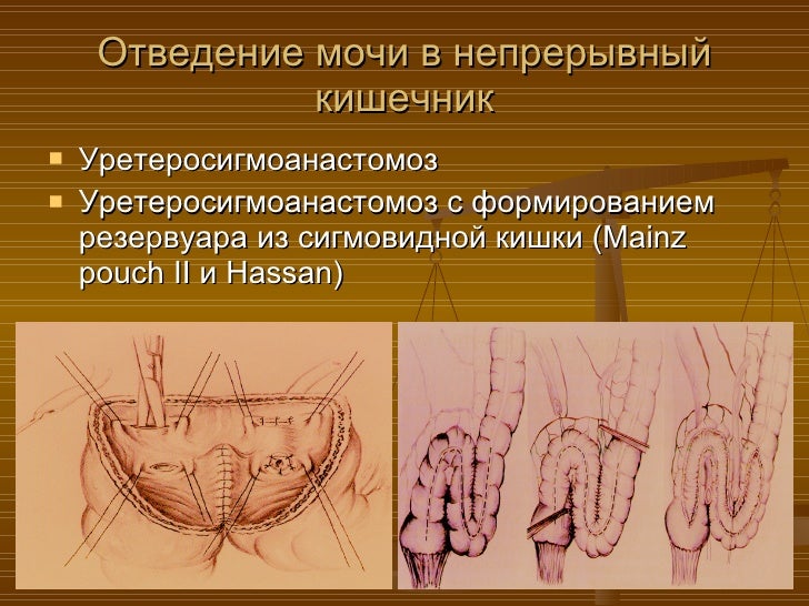 Состояние проблемы диагностики и лечения рака мочевого пузыря