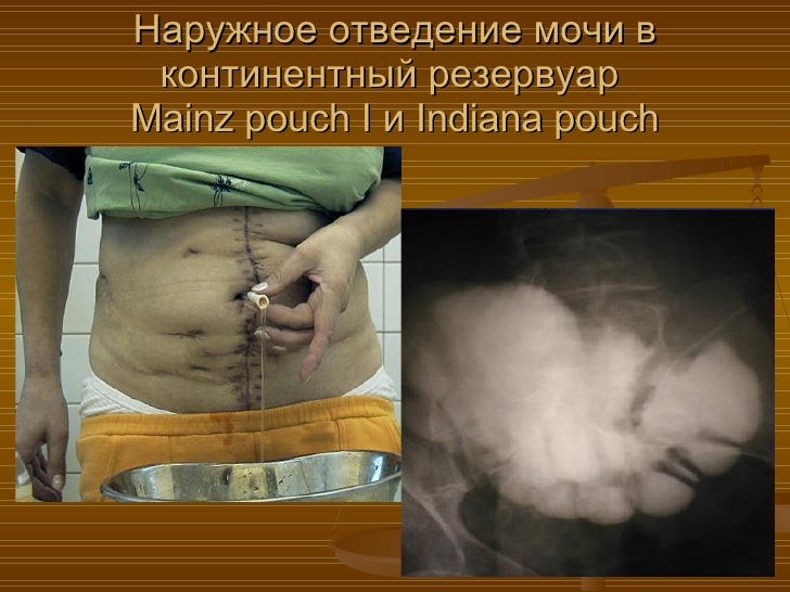 Состояние проблемы диагностики и лечения рака мочевого пузыря