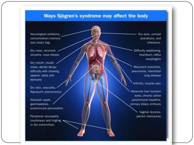 How do doctors diagnose Sjogren's syndrome?