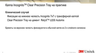18 10,13 All Rights Reserved.© 3M
3M Marketing
Клинический случай
Фиксации на нижнюю челюсть Incognito 7х7 с трансферной каппой
Clear Precision Tray на цемент RelyXTM U200 Automix
Брекеты на верхнюю челюсть фиксируются в обычной каппе из 2-х слойного силикона
Каппа IncognitoTM Clear Precision Tray на практике
 