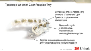 4 10,13 All Rights Reserved.© 3M
3M Marketing
Трансферная каппа Clear Precision Tray
Твердая прозрачная внешняя оболочка
для более стабильного позиционирования
Внутренний слой из прозрачного
силикона с "карманами" для
брекетов, определенными
компьютером
Брекеты Incognito
с основаниями,
обработанными
пескоструйным аппаратом
 