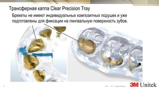 6 10,13 All Rights Reserved.© 3M
3M Marketing
Брекеты не имеют индивидуальных композитных подушек и уже
подготовлены для фиксации на лингвальную поверхность зубов.
Трансферная каппа Clear Precision Tray
 
