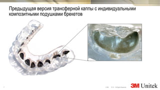 7 10,13 All Rights Reserved.© 3M
3M Marketing
Предыдущая версия трансферной каппы с индивидуальными
композитными подушками брекетов
 