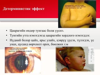 • Цацрагийн өндөр тунгаас болж үүснэ.
• Тунгийн утга нэмэгдэхэд цацрагийн хордлого нэмэгддэг.
• Нүдний болор цайх, арьс улайх, цэврүү үүсэх, түлэгдэх, үс
унах, цусанд өөрчлөлт орох, бөөлжих г.м
Детерминистик эффект
 