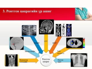 Рентген
цацраг
3. Рентген цацрагийн үр ашиг
Компьютер
томографи
ангиографи
шүдний
СРТ
ПЭТ
Туяа
эмчилгээ
Рентген
зураг
 