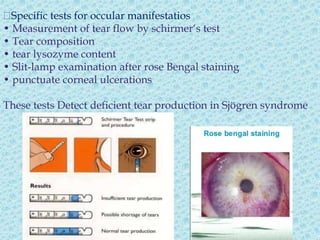 Sjogren s Syndromee PPTX Sjogren s Syndromee PPTX