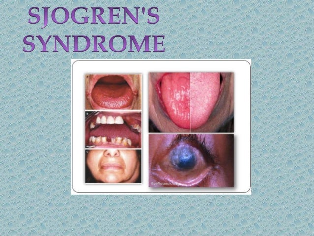 Sjogrens Syndromee