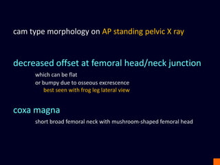 cam type morphology on AP standing pelvic X ray
decreased offset at femoral head/neck junction
which can be flat
or bumpy due to osseous excrescence
best seen with frog leg lateral view
coxa magna
short broad femoral neck with mushroom-shaped femoral head
 